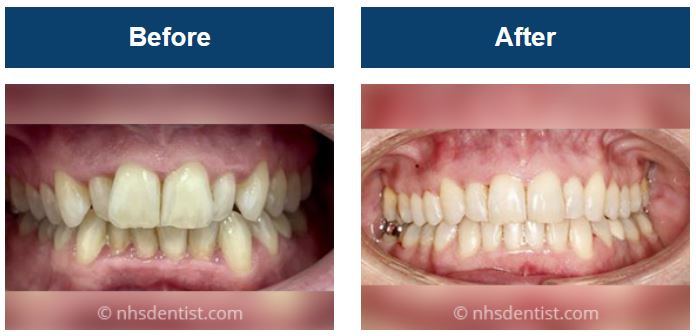 invisalign-before-after