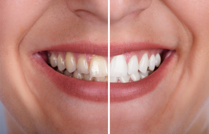 teeth-whitening-fulham