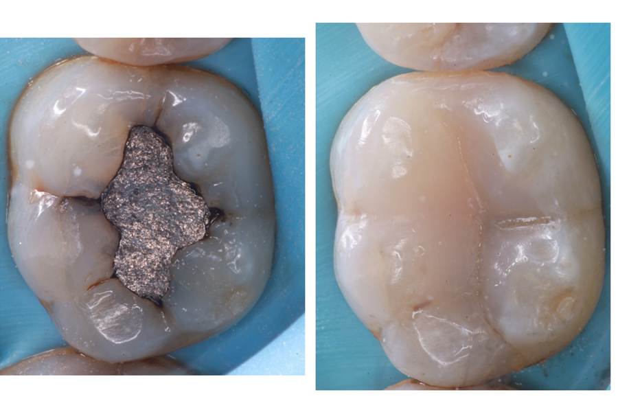 silver-and-white-fillings-fulham