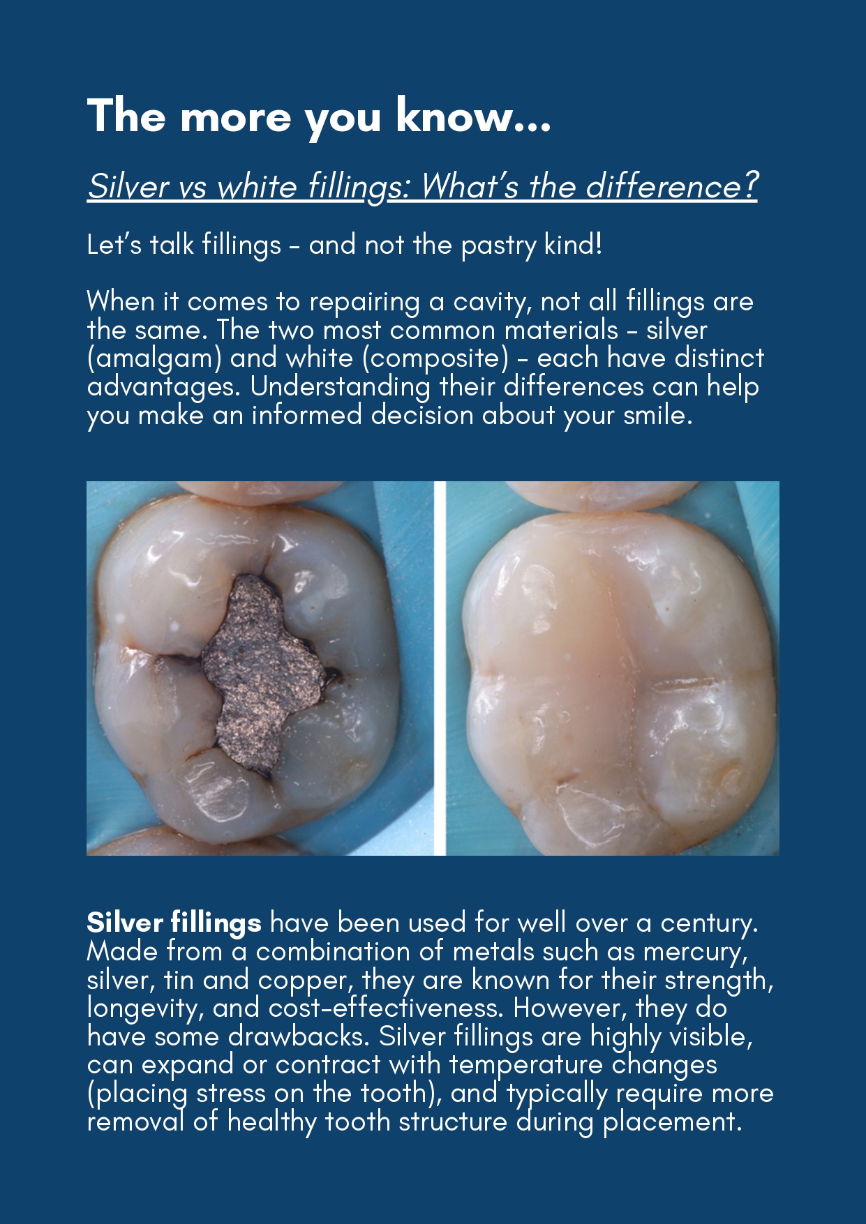 silver-white-fillings